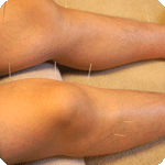 膝関節痛の鍼灸