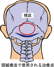 頭鍼療法 視区