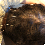 平衡区への鍼灸治療