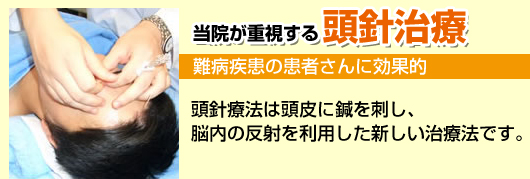 頭針療法は頭皮に鍼を刺し、脳内の反射を利用した新しい治療法です。